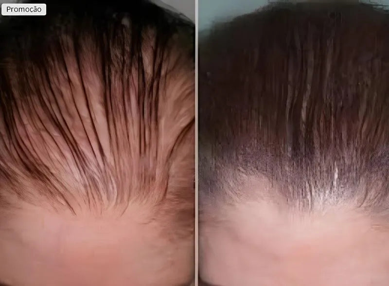 Paralisa a Queda e Acelera o Crescimento Capilar - Growth Hair