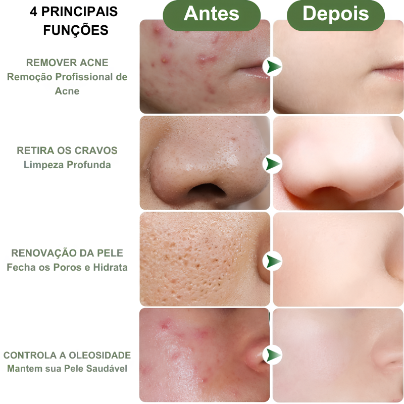 Hidratante Facial que Remove Acnes e Renova a Pele